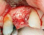 If bone width is inadequate it can be regrown using either artificial or cadevaric bone pieces to act as a scaffold for natural bone to grow around.