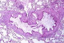 A tissue cross section of the airway showing a stained pink wall and an inside full of white mucous