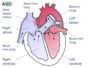 Diagram of the four chambers of the heart. There is a gap in the wall between the upper-left and upper-right chambers