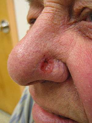 Solitary, pink, pearly appearing skin lesion on the side of an adult nose