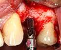 A series of slow-speed drills create and gradually enlarge a site in the jaw for the implant to be placed. The hole is called an osteotomy.