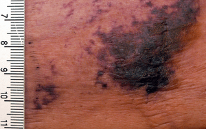 Multiple purpura and early necrosis of skin