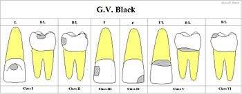 Chart showing digitally drawn images of caries locations and their associated classifications.