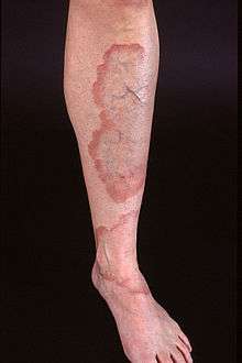 Large, well demarcated plaques with red, active borders, all located on the lower leg of an adult