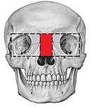 Box osteotomy